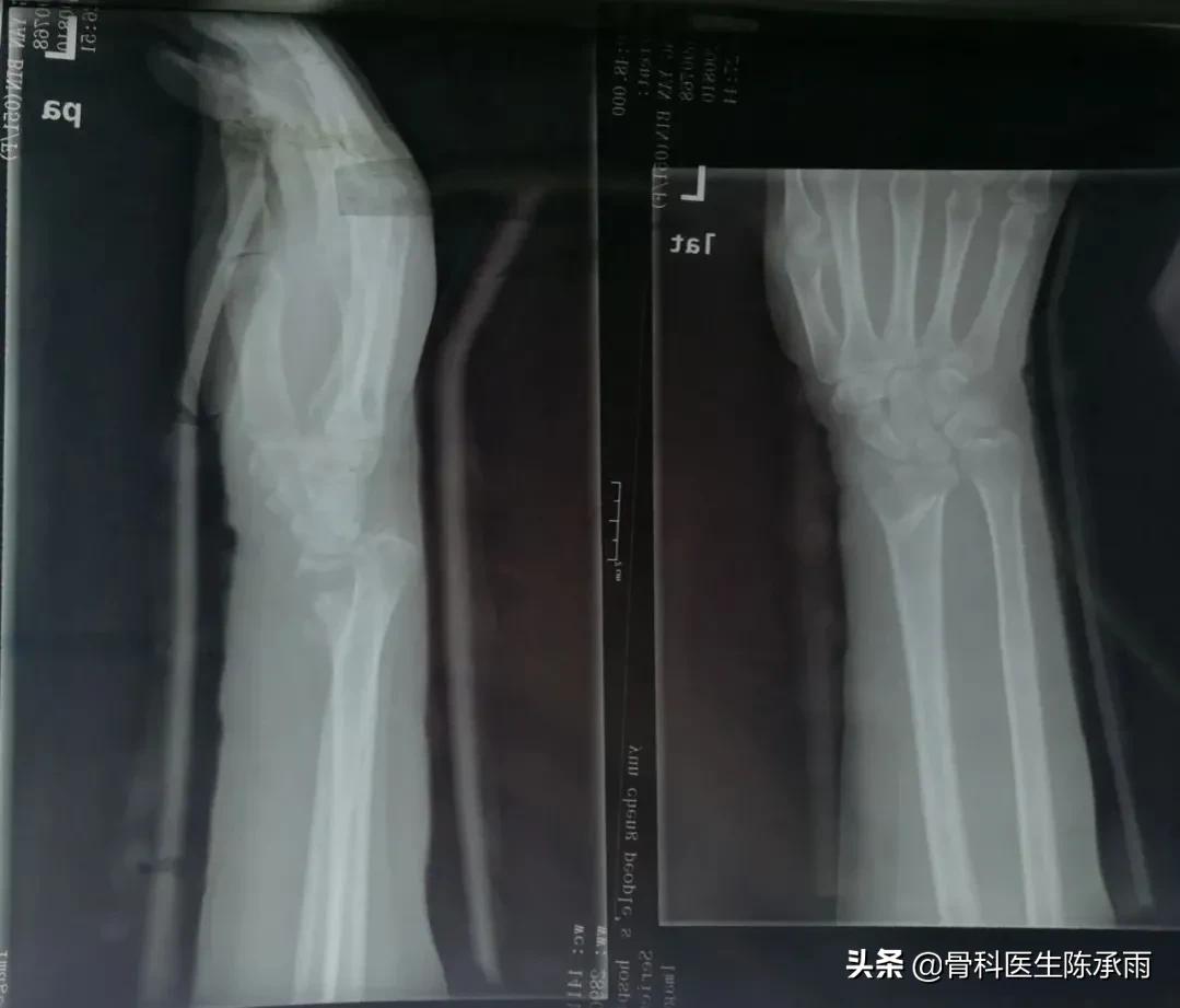 桡骨远端骨折累及关节面保守治疗,桡骨骨折保守还是手术