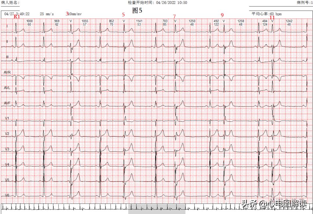 可见室性融合波是什么意思,室性融合波什么意思