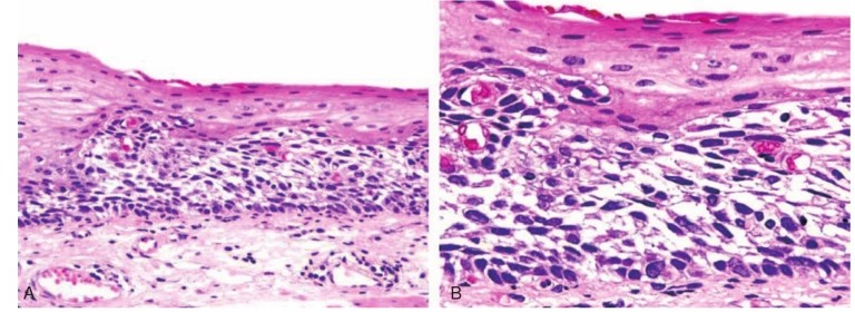 医生科普食管腺癌的发病原因,腺癌是什么原因引起的