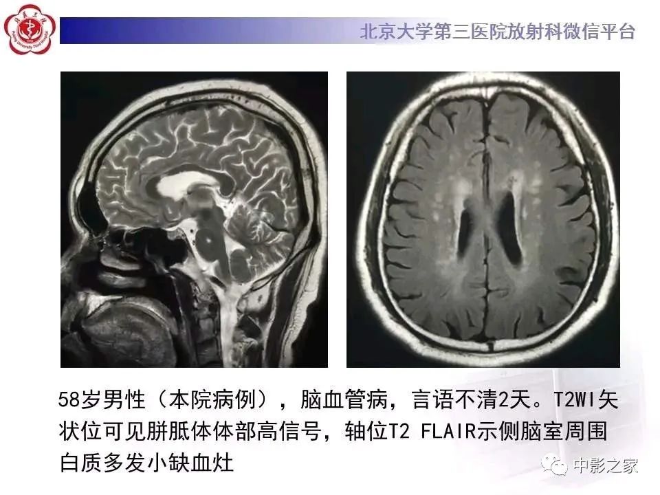 什么叫原发性胼胝体变性,原发性胼胝体变性治疗多少钱