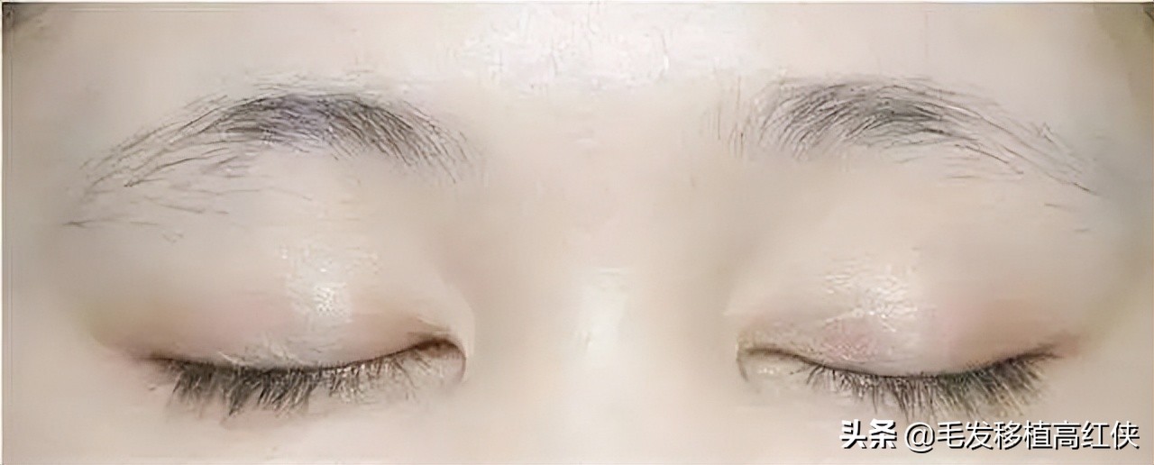 男人眉毛稀疏就要植眉,眉毛稀疏怎么植眉