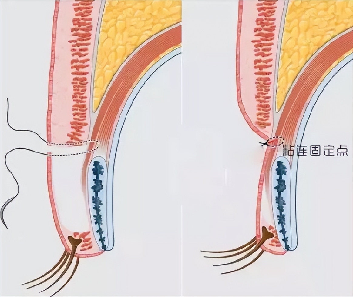 双眼皮的形成原因是什么？如何让单眼皮变成自然的双眼皮？