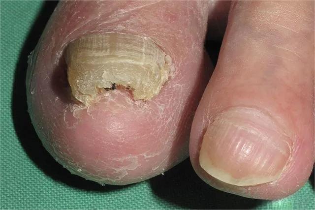 甲癣不严重怎么治疗,甲易生治疗灰指甲吗