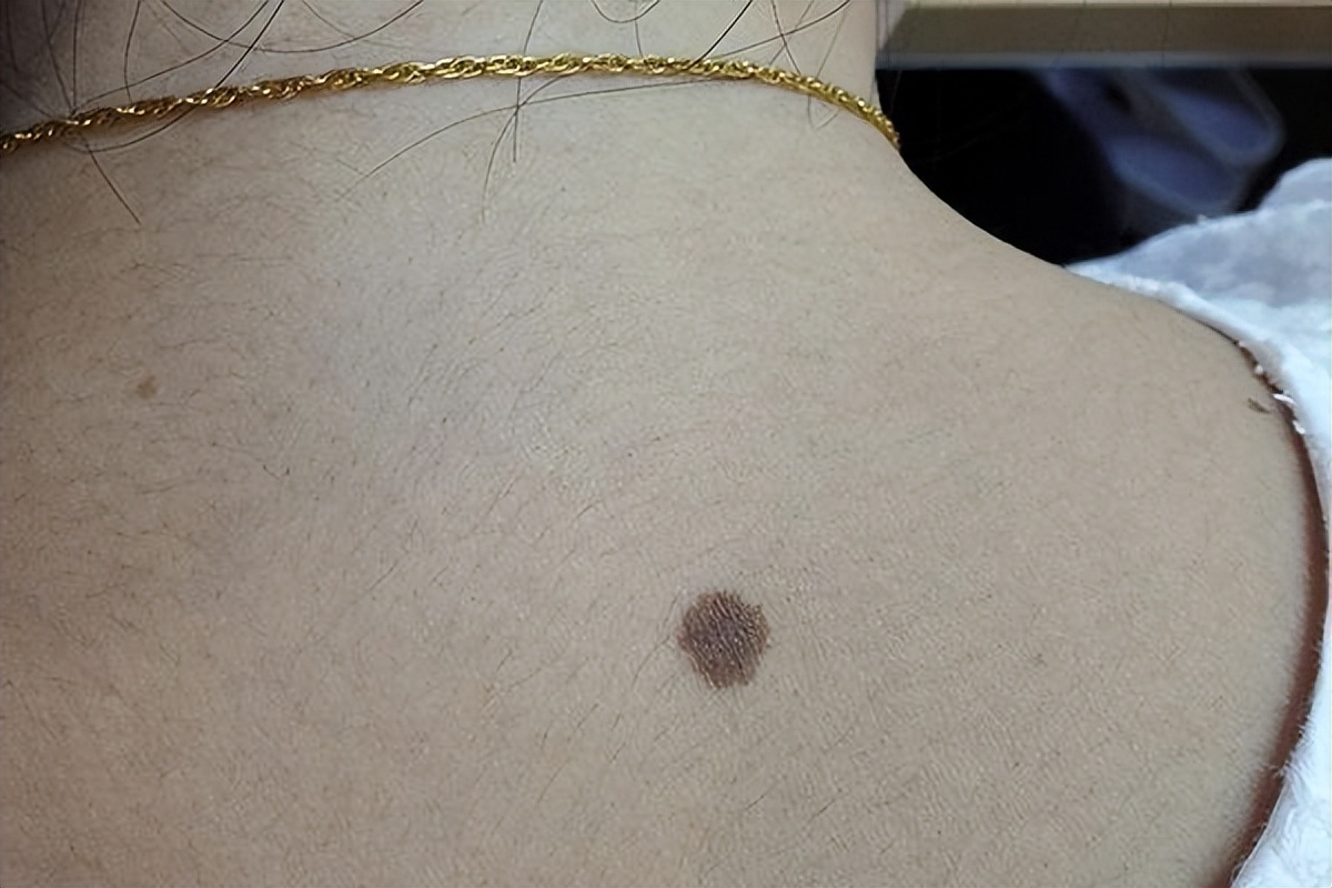 医生如何检查黑痣和黑色素瘤,医生长在摩擦部位的黑痣要当心