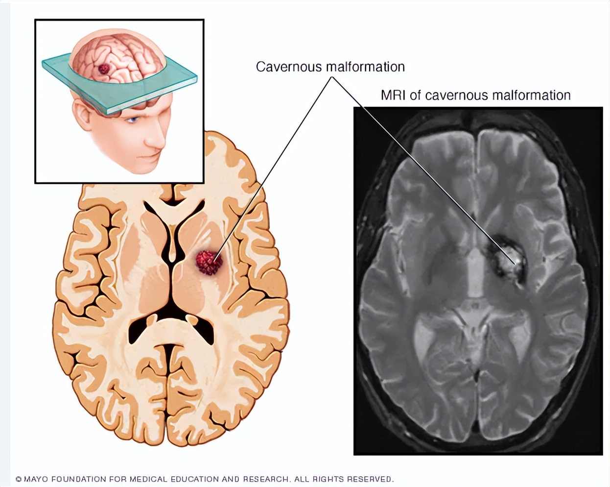 脑海绵状血管瘤引起癫痫怎么治,脑右侧顶叶海绵状血管瘤的危害