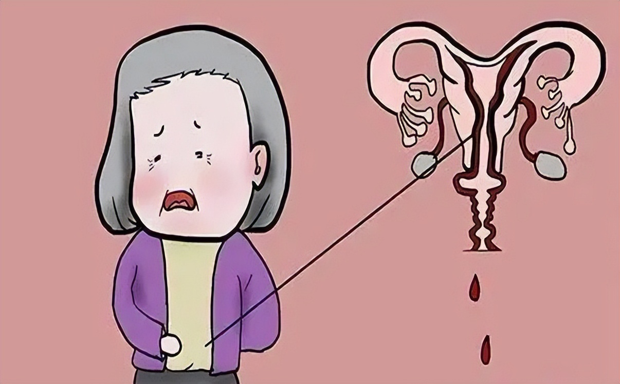 *处私**不规律出血原因很多，最坏的可能会是宫颈癌