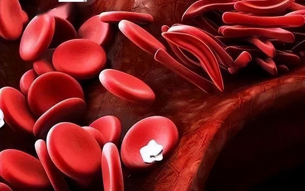 结肠息肉切除止血有哪些方法,直肠息肉切除术止血方法