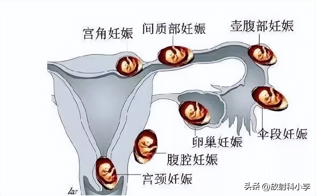 妇科急腹症的ct表现,妇科急腹症的诊断与治疗