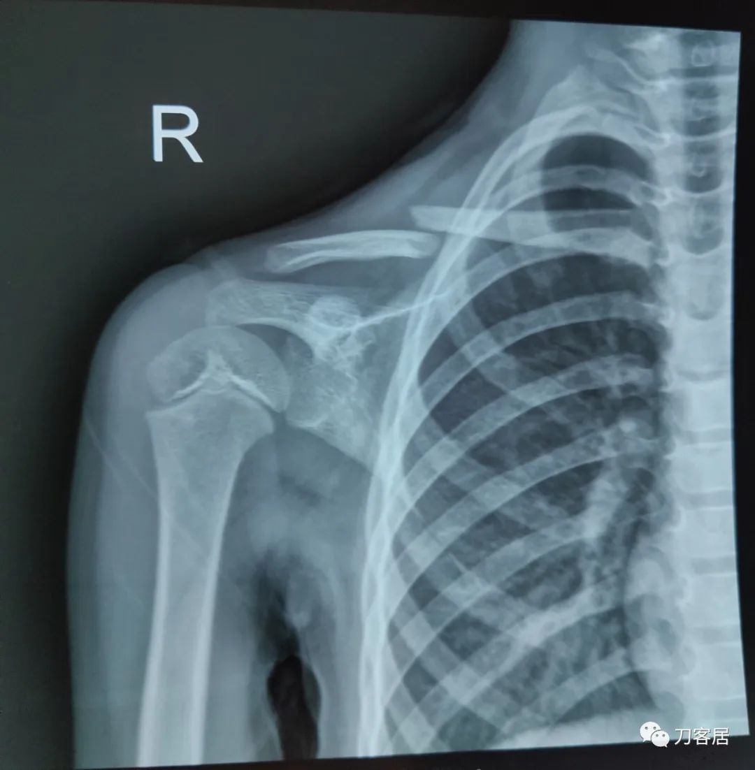 儿童锁骨骨折保守治疗的弊端,锁骨粉碎骨折错位不处理会愈合吗