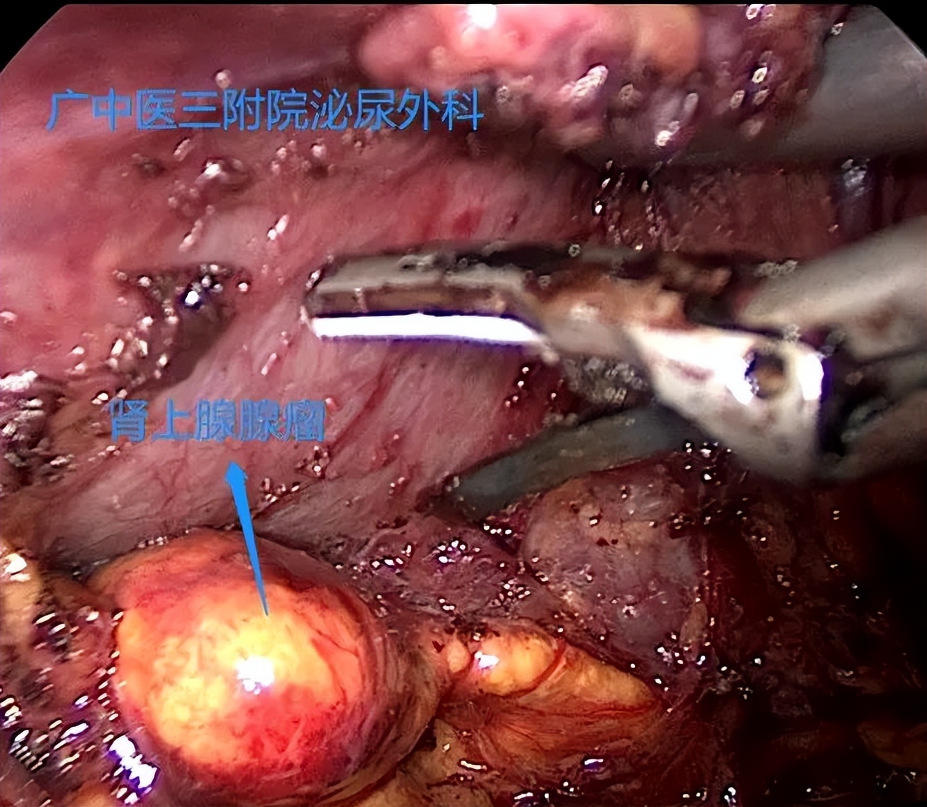 吃三种降压药都降不下应该怎么办,吃3种降压药降不下来是血脂高吗