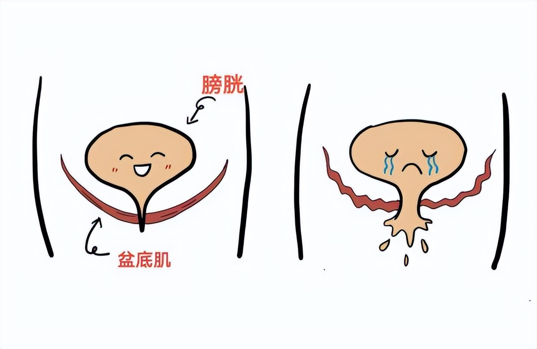关爱女性关注盆底健康,市人民医院关爱女性健康