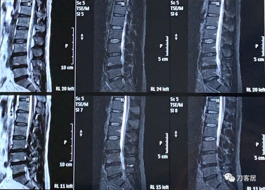 20岁腰5骶1椎间盘突出怎么办,腰5骶1椎间盘突出急性发作