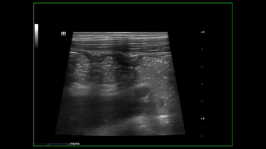 株洲市中心医院小儿超声检查克罗恩病为患者排忧解难