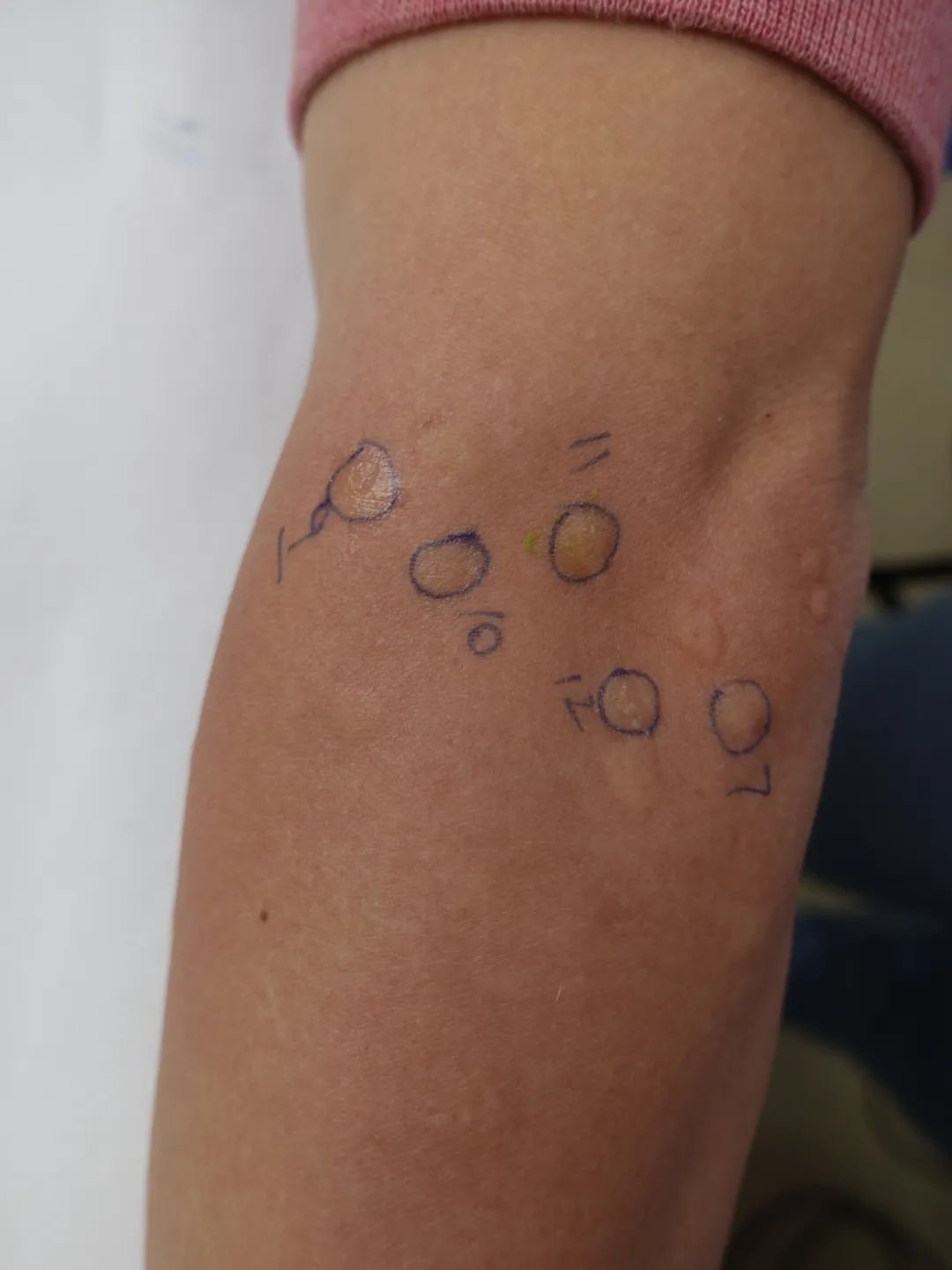 蚊子叮咬止痒消肿膏推荐,蚊虫叮咬止痒药膏测评推荐