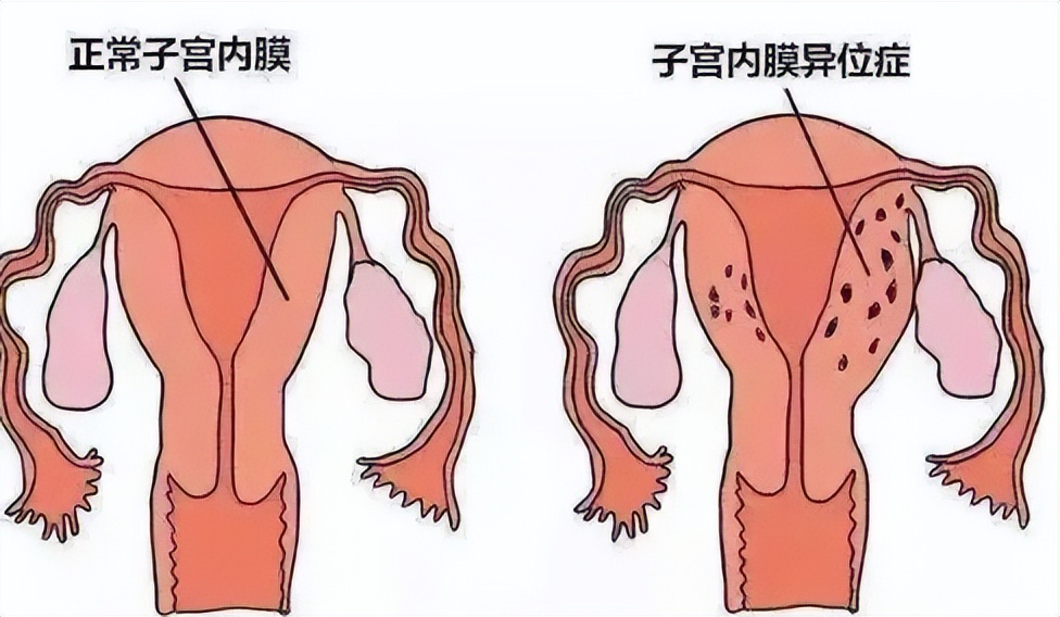 高考女生吃避孕药,高考前吃避孕药