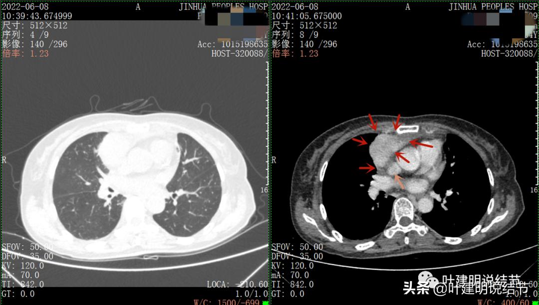 这位老乡，乏力来查，查出这么大个的纵隔肿瘤！会是什么呢？