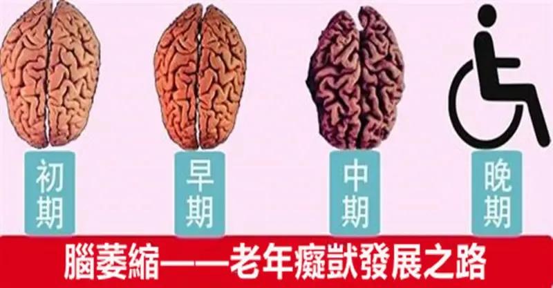 老人小脑萎缩可以治好吗,老人小脑萎缩如何改善