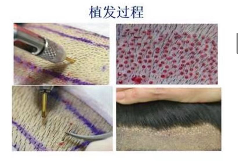 脱发脱得严重用什么防脱发,防脱要趁早改善脱发