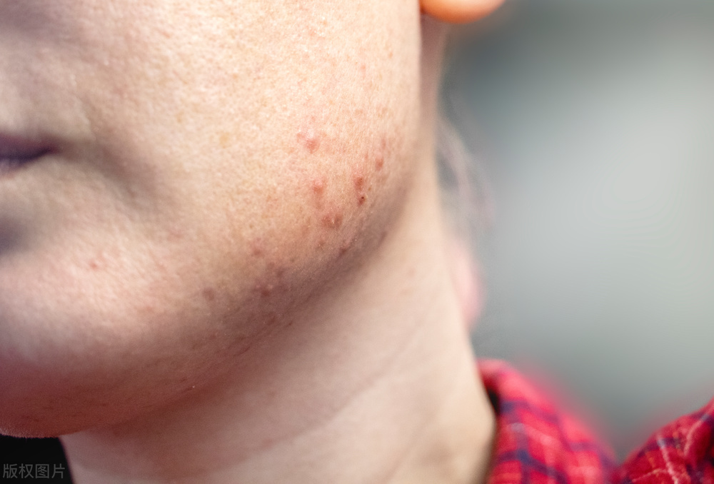 宫颈癌放疗有什么副作用,后装放疗的副作用