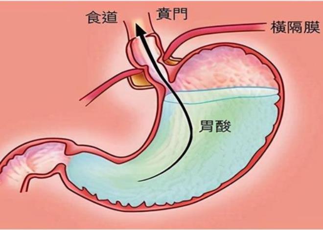 医生科普食管腺癌的发病原因,腺癌是什么原因引起的