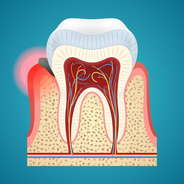 牙周病造成牙龈萎缩松动怎么办,牙齿松动牙龈易出血是肾虚吗