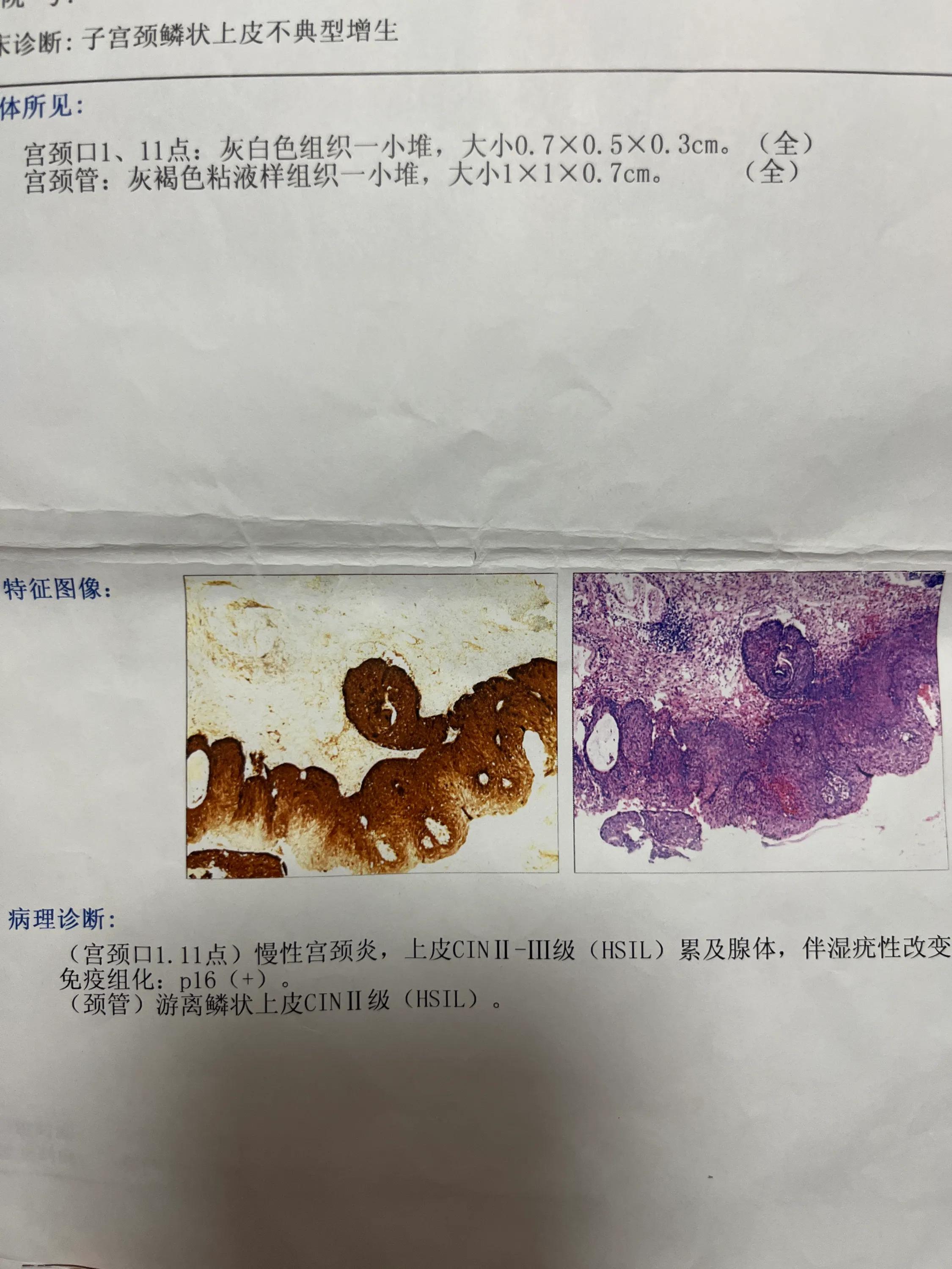 我患上了hpv82严重吗,hpv16弱阳自愈率