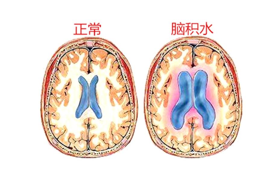 先天性脑积水能坚持多久,成人先天脑积水有必要治疗吗