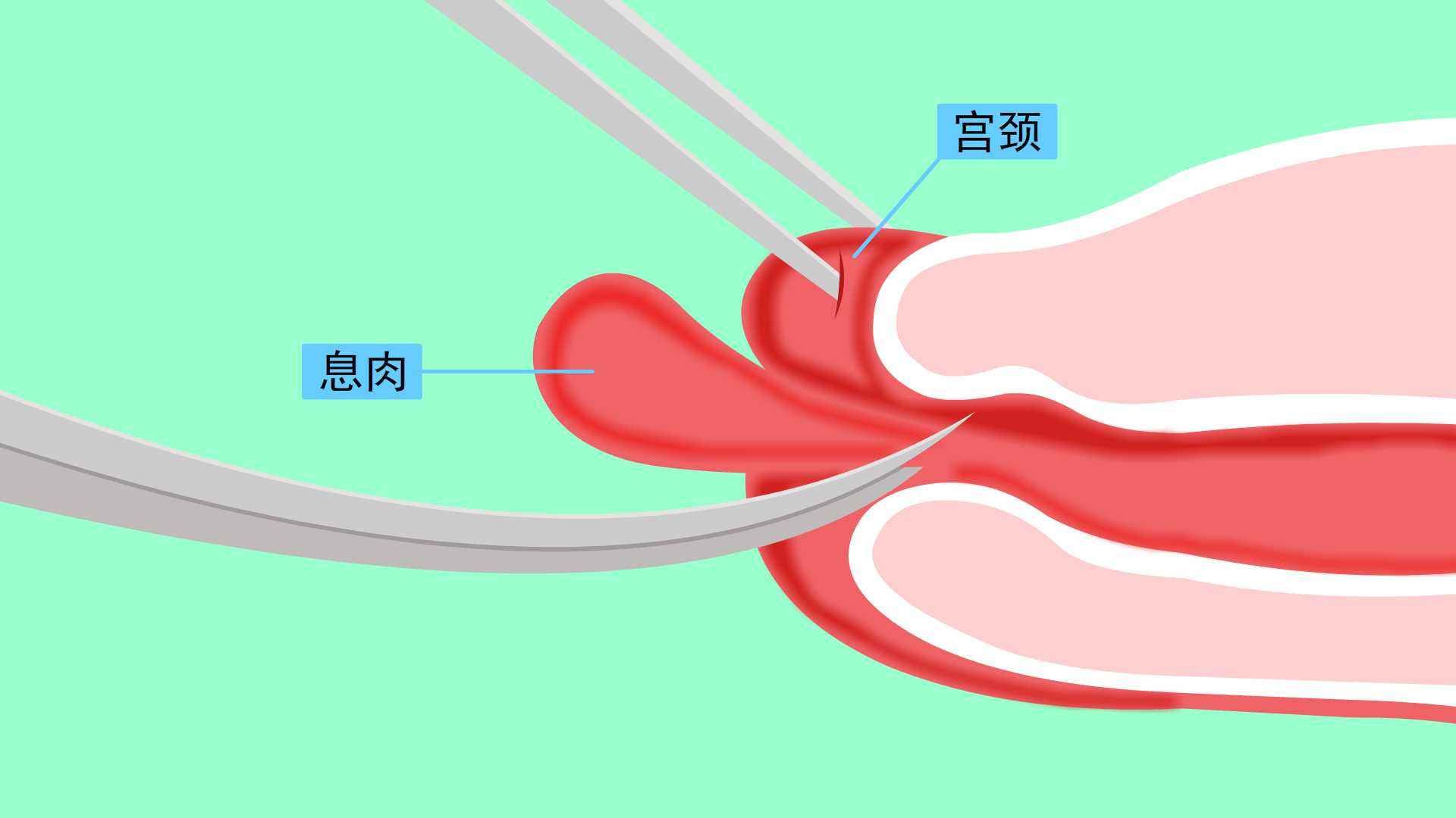 分泌物有褐色的血丝怎么回事,有血丝和褐色分泌物是什么情况