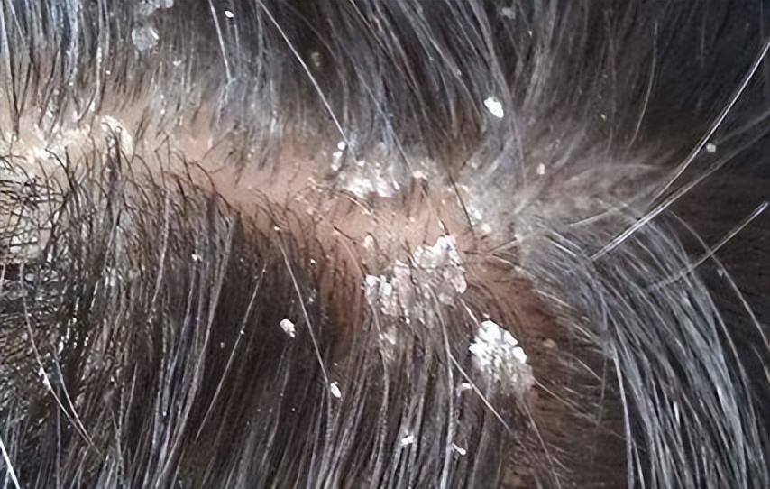 头皮屑很多头皮痒？头皮屑原因解析，3招改善头皮屑问题