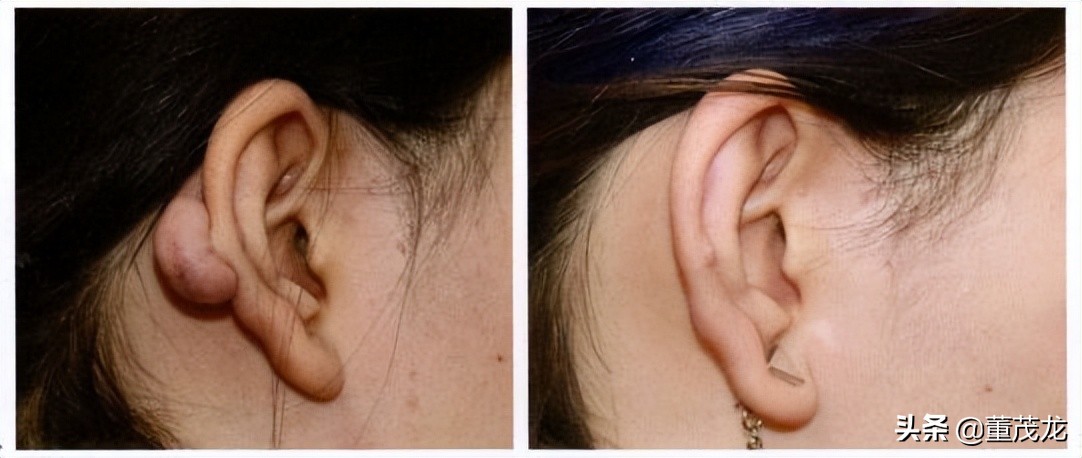 董茂龙说医:瘢痕的放射治疗