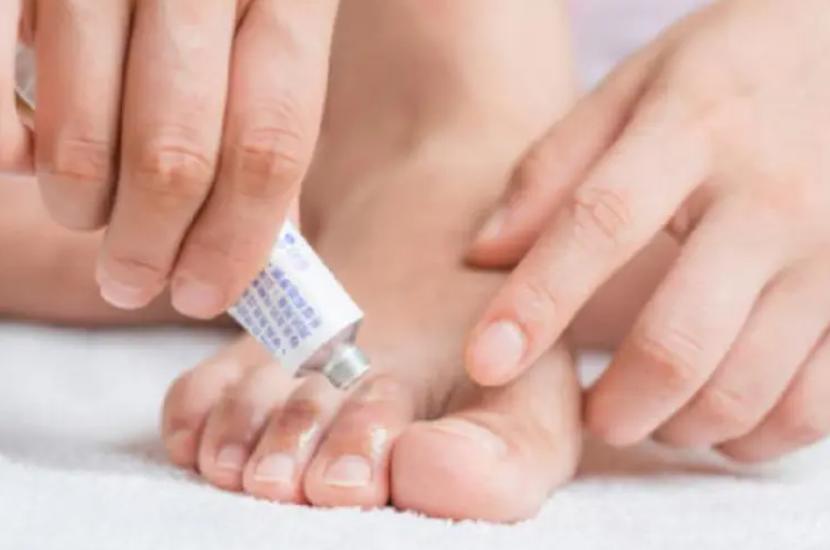 脚气真菌怎么治才能除根,脚气真菌怎么彻底消灭