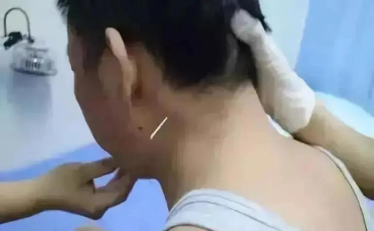 头部脑供血不足穴位,头部穴位针灸的作用