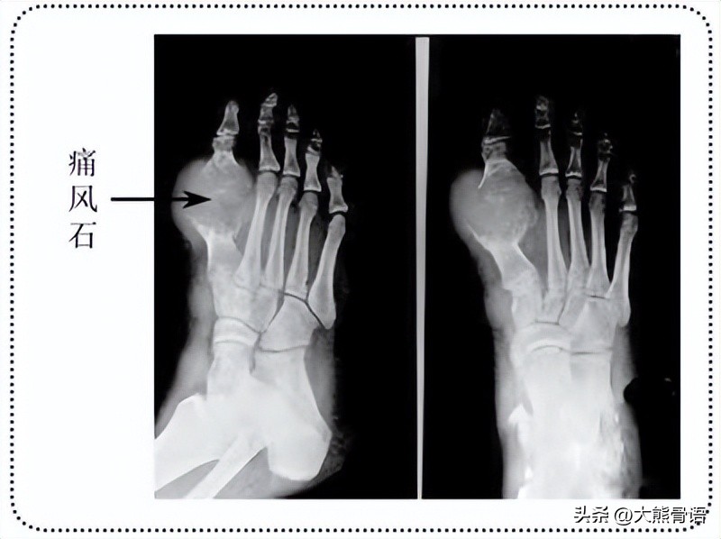 手指痛风的初期症状和治疗,脚踝痛风的症状和治疗方法