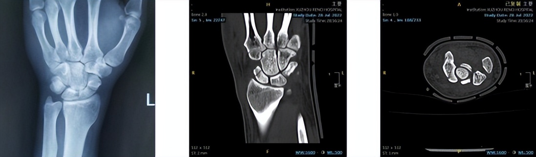 天玑机器人开创骨科微创先河,天玑骨科手术机器人