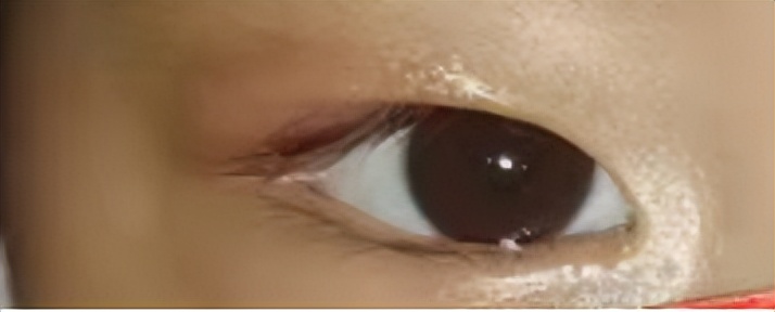 孩子长了针眼红肿出头了怎么处理,小儿针眼起脓包怎么办