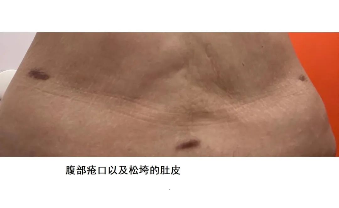 女子去抽脂手术后脸上溃烂,厦门华美整形医院抽脂