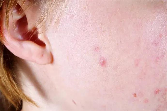 熬夜上火长痤疮怎么办,熬夜后便秘严重解决办法