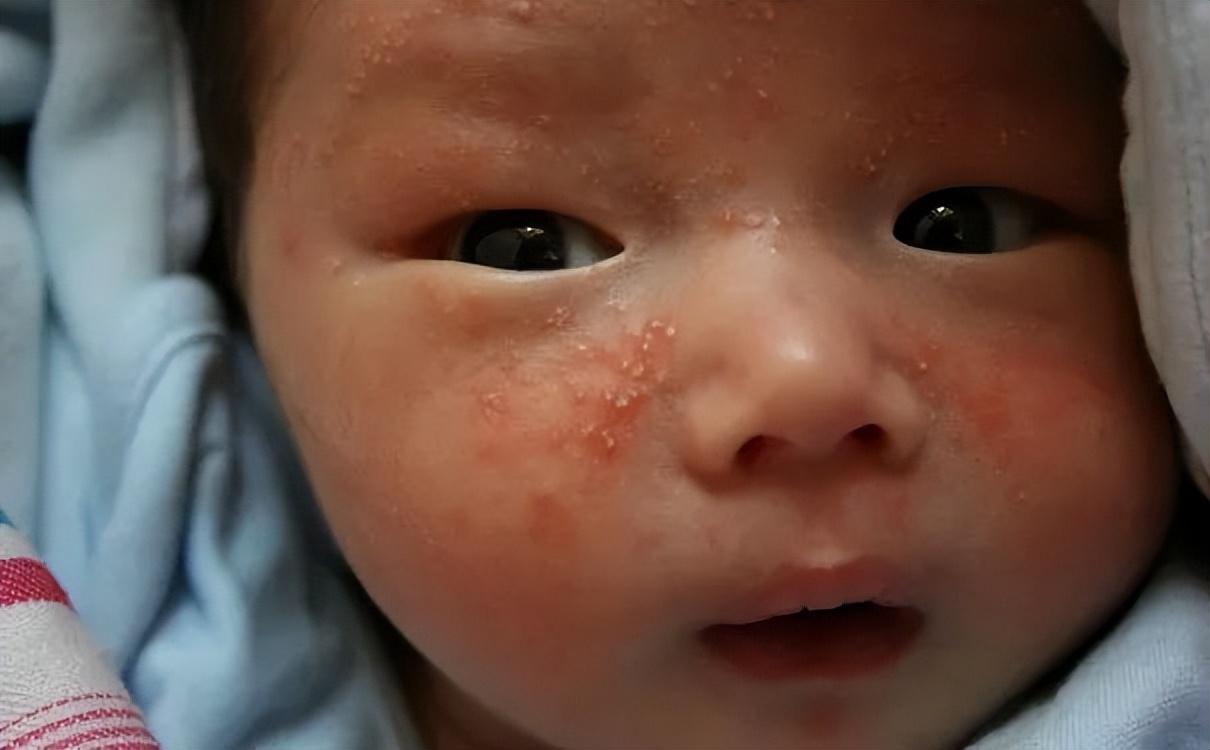 6月龄宝宝湿疹还吐奶怎么回事,婴幼儿感冒咳嗽吐奶怎么办