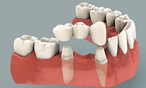 镶牙和种植牙有什么区别该怎么选,镶牙与种植牙的区别哪个比较好
