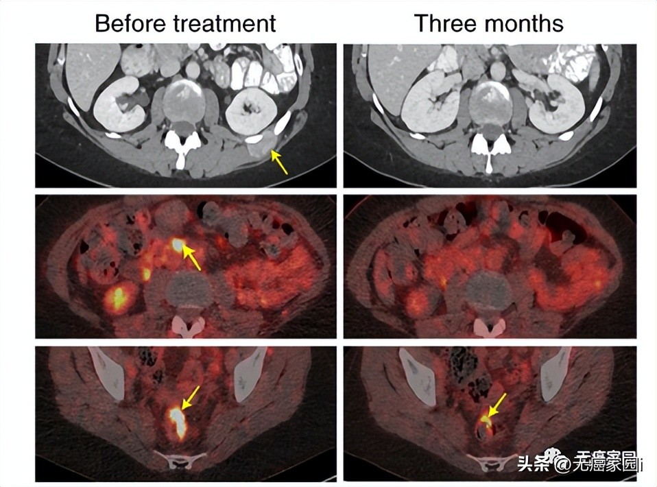 tcr-t疗法可以治疗哪些肿瘤,tcr-t细胞疗法成功率