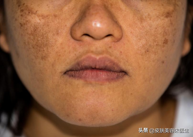 长凸出来的老年斑会是得了癌症吗,40岁老年斑增多是癌症的征兆