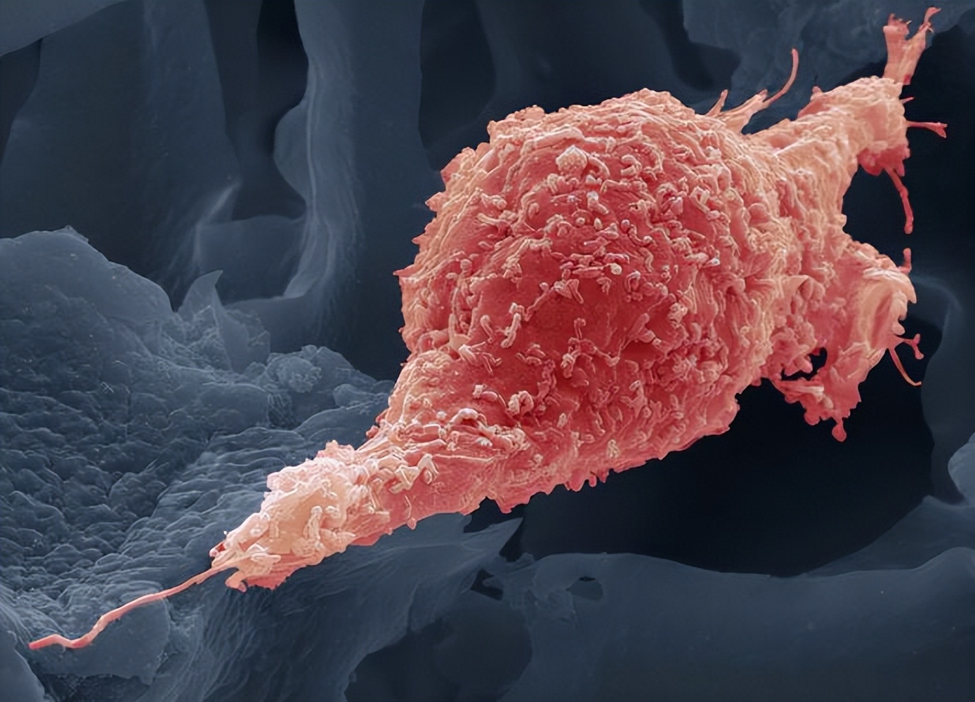 【科普】子宫内膜癌有两种类型，你了解吗？腹腔镜手术效果如何？