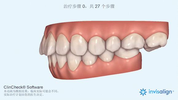 正畸治疗的基本矫治方法,正畸修复联合案例