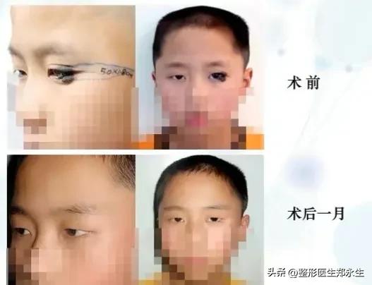 长在眼睛上的肿瘤,长在眼睛周围的痣