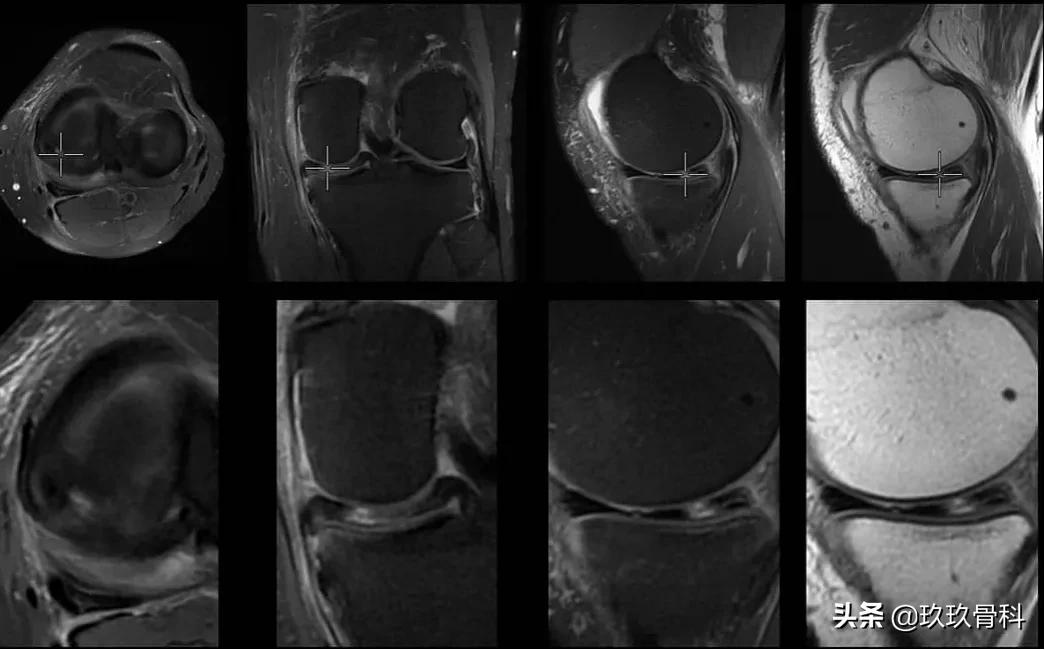 半月板损伤是否需要手术,外侧半月板损伤手术费用