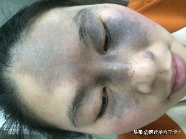 太田痣是怎么形成,太田痣是怎么形成的