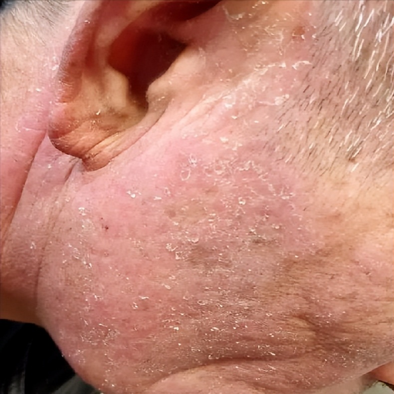 面部皮炎的症状和治疗方法,面部皮炎是怎么回事