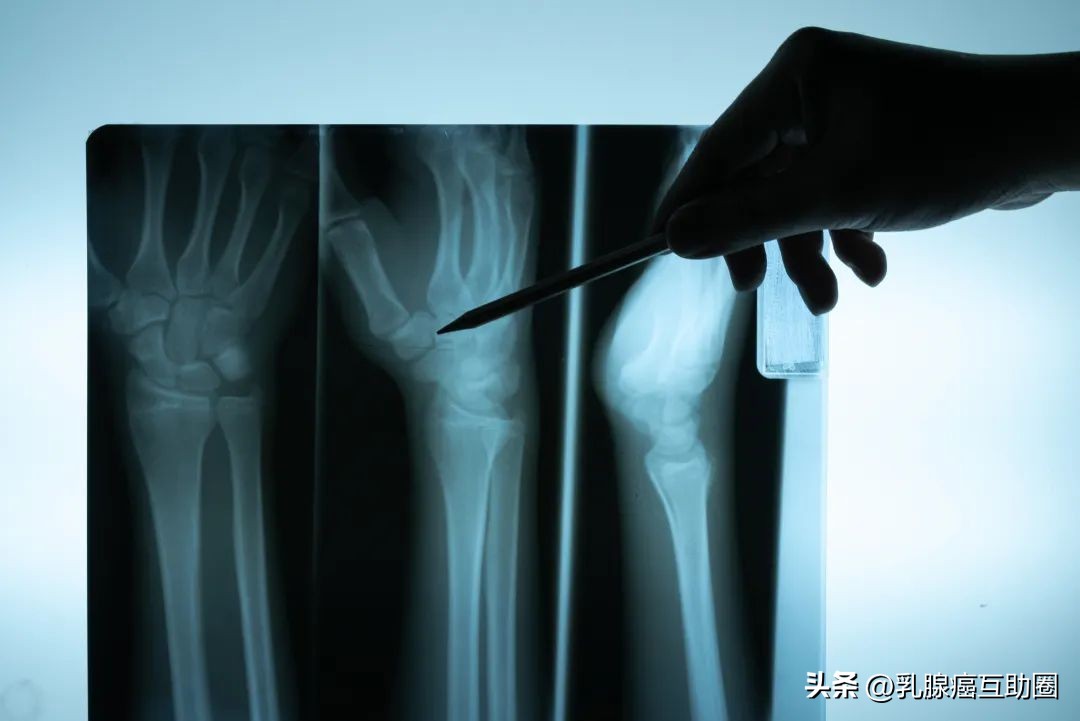 乳腺癌复发转移还有治愈的可能吗,乳腺癌一旦复发