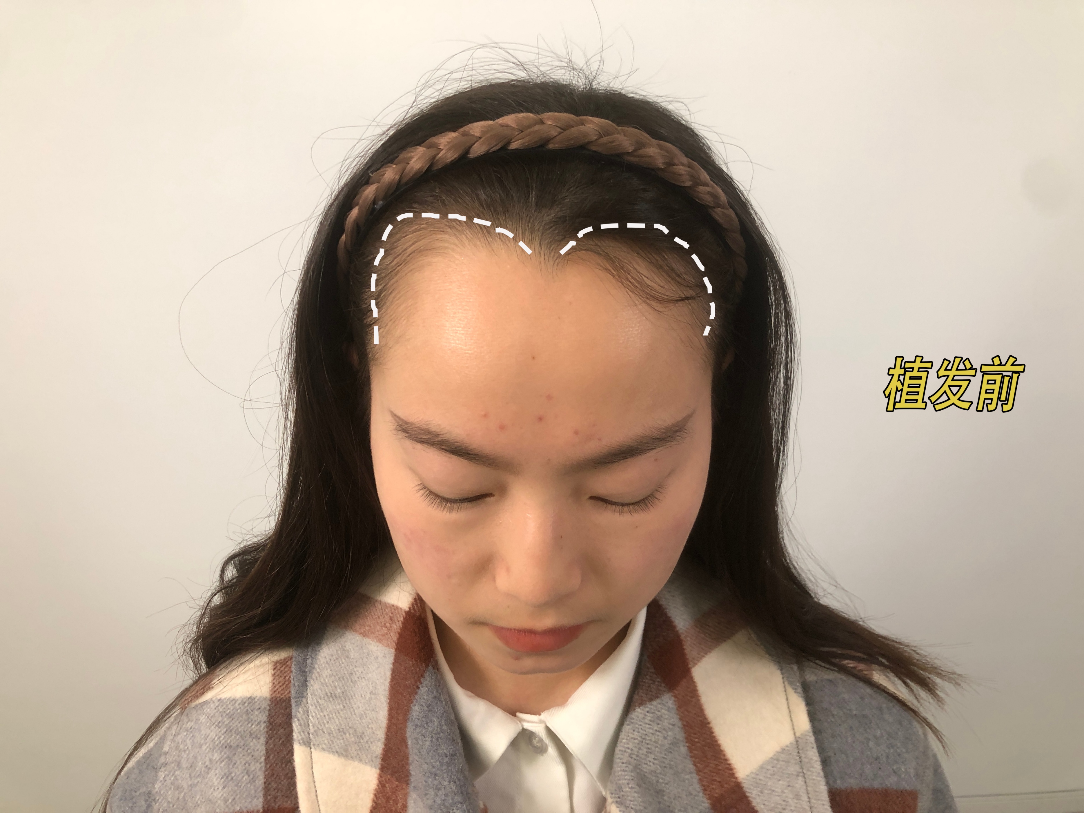 恒美植发需要多少钱,恒美植发跟碧莲盛植发