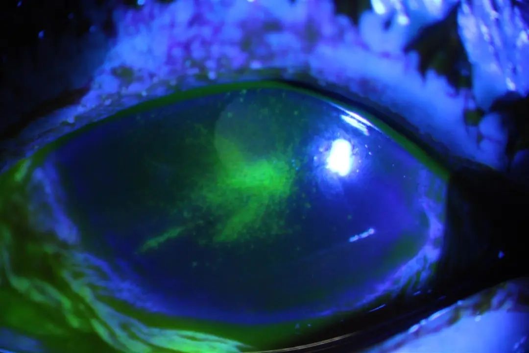 染发后，她“泪流满面”地走进眼科诊室